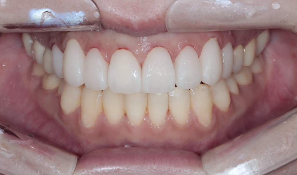 치아부식과 심미성을 동시에 잡은 앞니 치료 (ft. 역류성 식도염) 관련 이미지 11