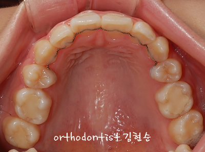 강남 돌출 (토끼 치아) 관련 이미지 27