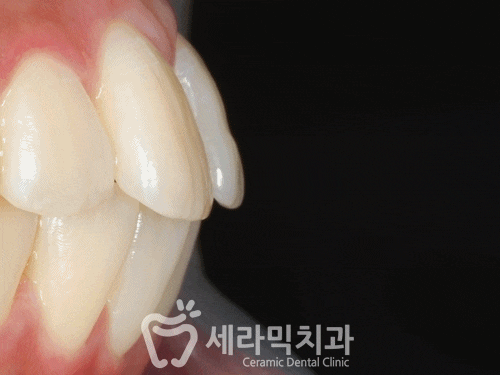 돌출입 투명교정으로 세련된 옆라인을 완성한 치아교정전후 관련 이미지 3