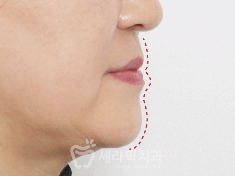 40대에 이어 50대 치아교정 전후사례 증가 추세 관련 이미지 15