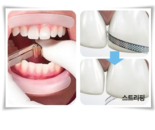 학동역치과 세라믹치과 앞니투명교정 관련 이미지 6