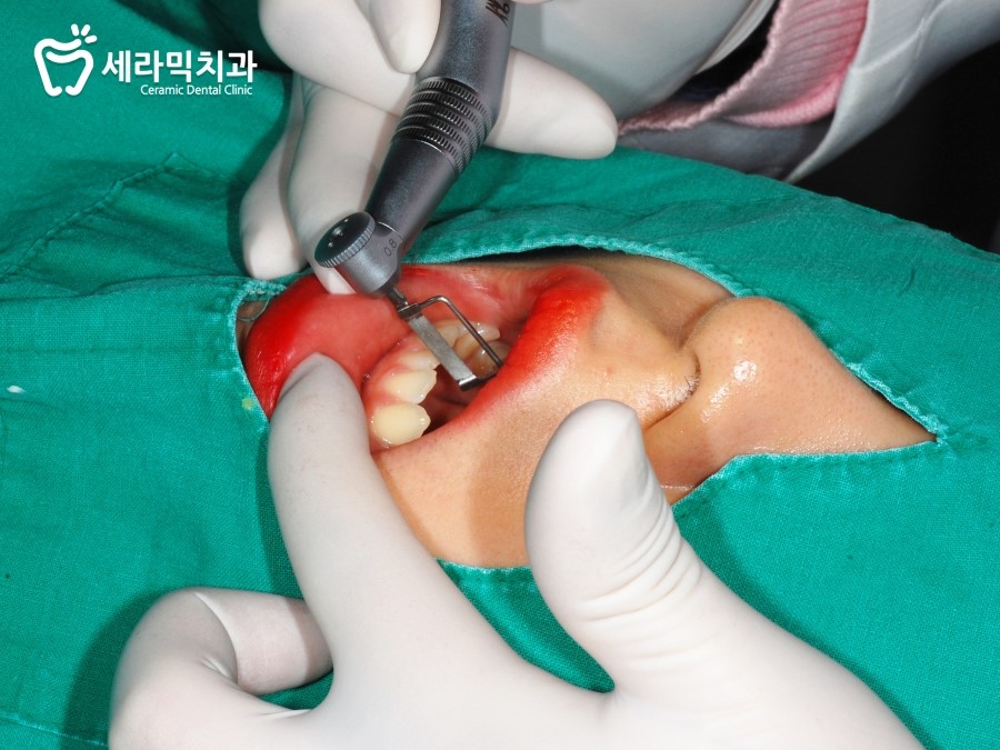 비발치교정 무조건 좋은 것만은 아니다? 관련 이미지 5