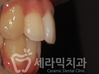 치아교정 전후 확연한 인상 변화! 관련 이미지 12
