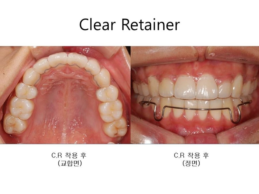 학동역치과 치아교정 잘하는 곳 ! 관련 이미지 26