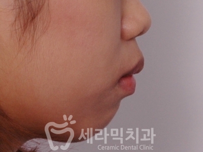 돌출입과 개방교합 치아교정 치료전후 관련 이미지 9
