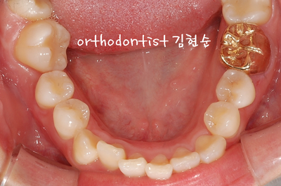 강남 덧니, 돌출 관련 이미지 7