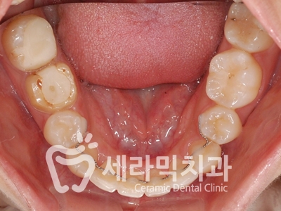 토끼이빨, 틀어진 치아배열 세라믹교정 전후사진 관련 이미지 24