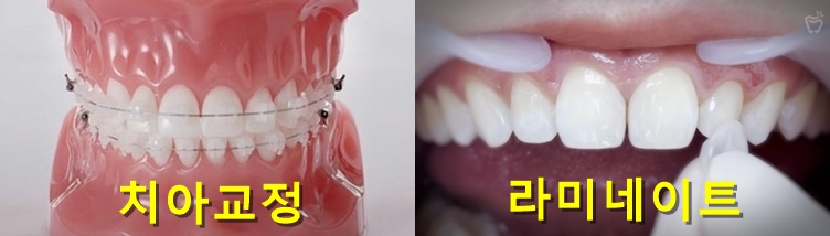 치아교정 VS. 라미네이트. 뭐가 좋은 걸까요? 관련 이미지 1