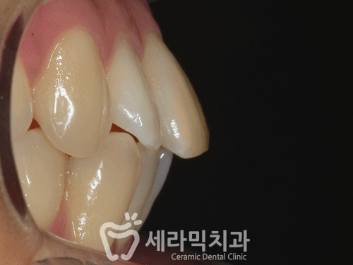 돌출입 치아교정전후, 갸름하고 부드러운 옆라인 완성! 관련 이미지 4