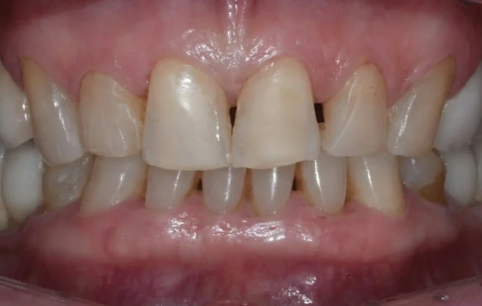 청담 치과, 양치할 피가 섞여 나온다면 - 치주염 관련 이미지 3