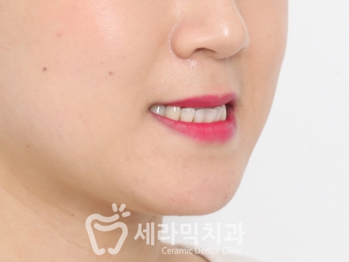 반대교합과 아래 돌출입 치아교정전후 관련 이미지 5