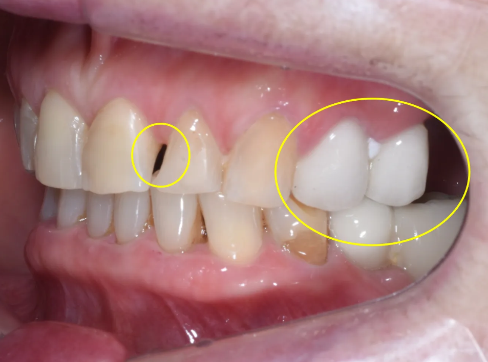 강남구청역 치과, 70대 외국인 환자의 라미네이트 관련 이미지 5
