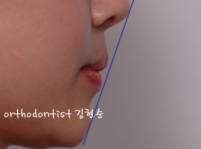 강남 덧니, 돌출 관련 이미지 32