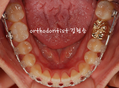 반대 교합 관련 이미지 24