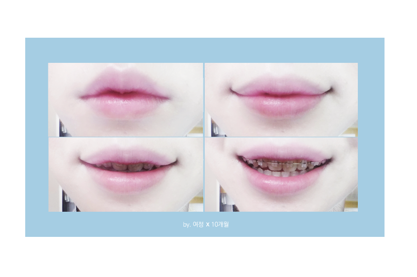 세라믹치과 치아교정일기 - 김여정 관련 이미지 6