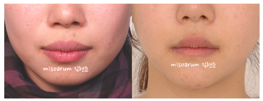 발치 돌출입교정으로 인상개선, 동안 만들기 관련 이미지 10