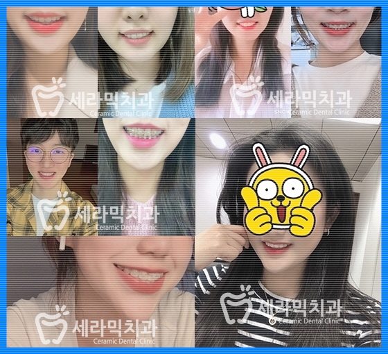 돌출입 치아벌어짐 치아재교정 전후. 세라믹치과 관련 이미지 11