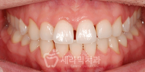20대 남자 앞니벌어짐 개선사례, 성인 치아교정전후 달라진 Smile~ 관련 이미지 7