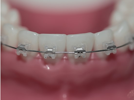 강남 세라믹 교정 관련 이미지 3