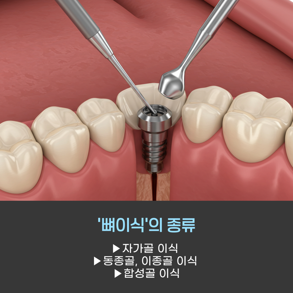 '임플란트 뼈이식' 전에 알아야 할 3가지 관련 이미지 3