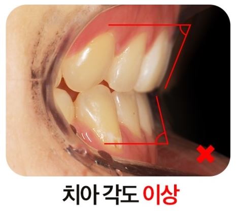 발치교정 부작용 옥니 해결법 관련 이미지 6