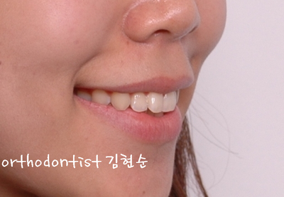 강남 돌출 관련 이미지 4