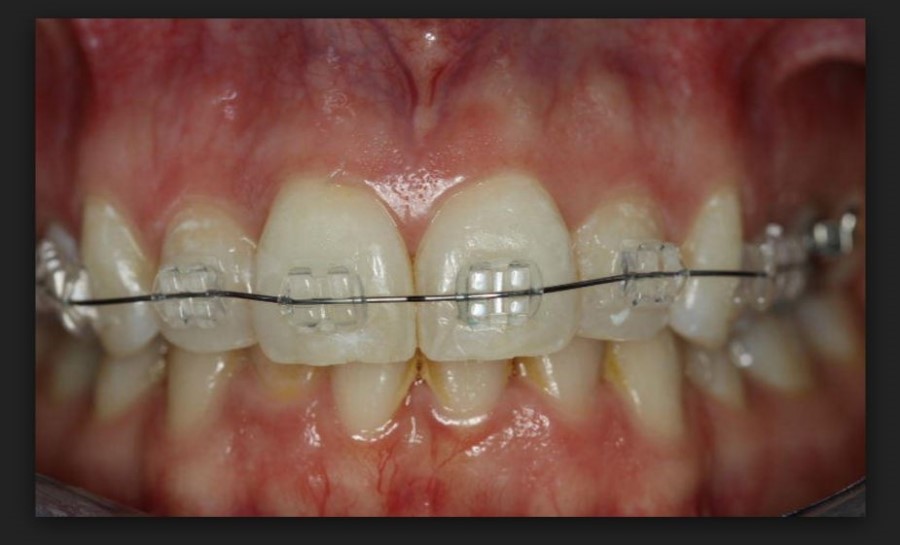 치아교정 부작용 탈회와 치아우식 관련 이미지 2