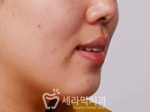 개방교합 때문에 시작한 치아교정. 돌출과 무턱까지 한번에 해결! 관련 이미지 1