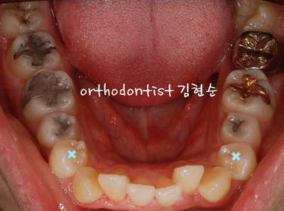 강남 돌출 관련 이미지 15