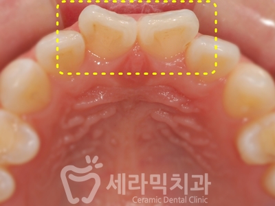 앞니 돌출, 나비치아를 남몰래 해결한 치아교정 전후! 관련 이미지 14