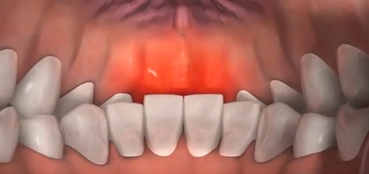 과개교합 ABP 교정 관련 이미지 4