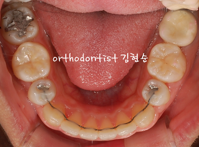 강남 돌출 관련 이미지 29