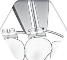 세라믹교정 세라믹치과 세밀하고 정확하게! 더 아름답고 건강한 치아를 만듭니다. 관련 이미지 7