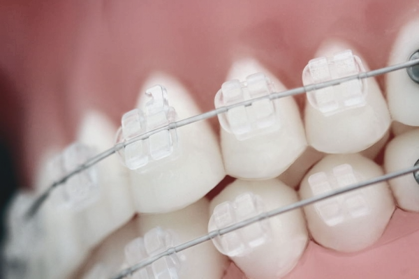 학동역치과 하면 세라믹교정 ~ 관련 이미지 6