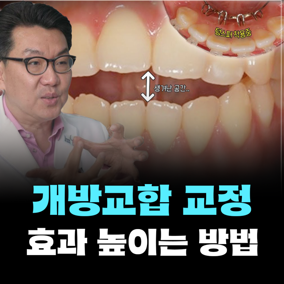 '개방교합' 치료법과 근본적인 해결방법 (feat. 비수술 치아교정) 관련 이미지 1