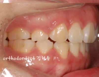 강남치아교정추천 관련 이미지 22