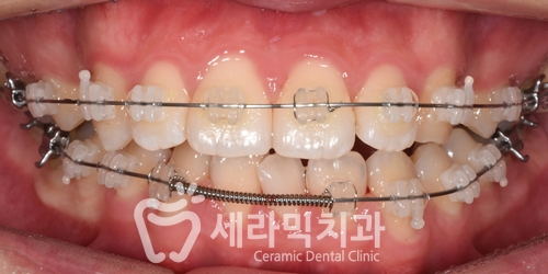과개교합과 돌출입 개선으로 달라진 인상, 세라믹치과 치아교정전후! 관련 이미지 8