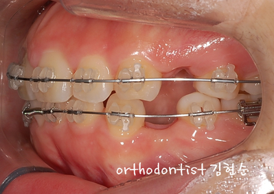 강남 돌출 관련 이미지 22