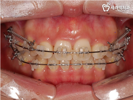 돌출 교정 월15만원 관련 이미지 3