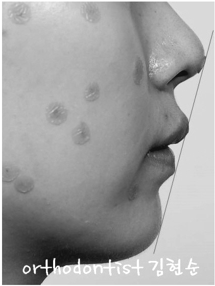 강남 과개 교합 관련 이미지 10