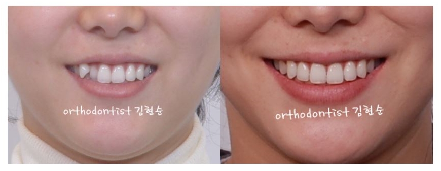 세라믹교정 은 "세라믹 치과 " 관련 이미지 6