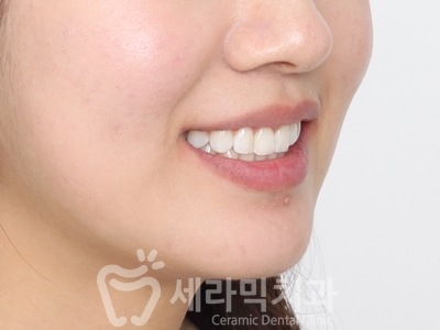 앞니 돌출, 나비치아를 남몰래 해결한 치아교정 전후! 관련 이미지 20
