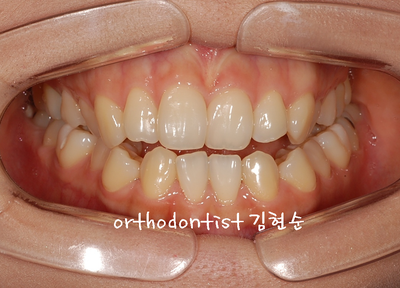 개방 교합 관련 이미지 5