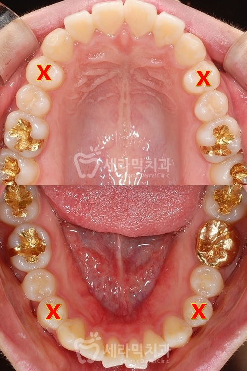 20대 돌출입교정, 무턱교정, 치아교정전후 세련된 얼굴 라인을 되찾다! 관련 이미지 9