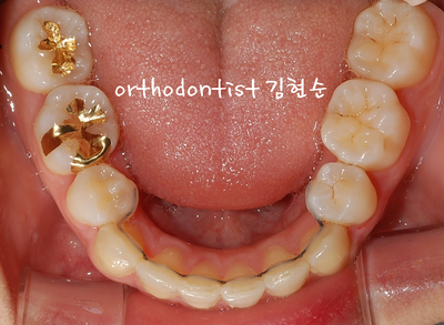 강남 돌출 관련 이미지 25