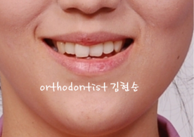 개방교합 비발치 세라믹교정 관련 이미지 1