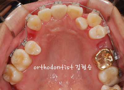 강남 덧니, 돌출 관련 이미지 20