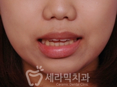 돌출입과 개방교합 치아교정 치료전후 관련 이미지 3