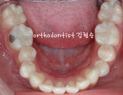 강남 돌출 관련 이미지 9