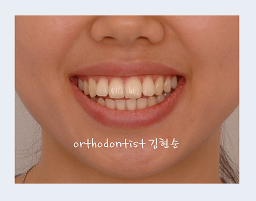 강남교정치과 관련 이미지 4